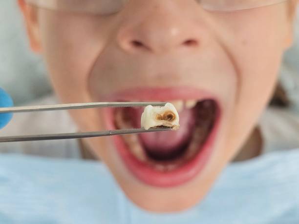 Best Emergency Dental Care for Broken or Chipped Teeth in Manorhaven, NY